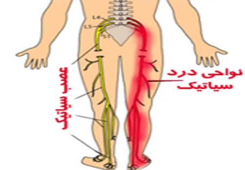 درمان سیاتیک(عرق النساء)در طب اسلامی