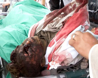 (18+) تصاویر جنایات وحشیان آل سعود علیه کودکان یمنی